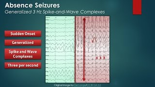 What are seizures [upl. by Naret]