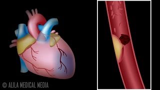 Myocardial Infarction and Coronary Angioplasty Treatment Animation [upl. by Eahsel746]