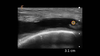 Knee Effusion Ultrasound Image Interpretation [upl. by Isolda665]