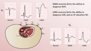 Intro to EKG Interpretation  Bundle Branch Blocks [upl. by Niledam342]