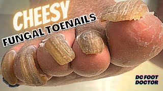 Cheesy Fungal Toenails Trimming Long Toenails [upl. by Forland]