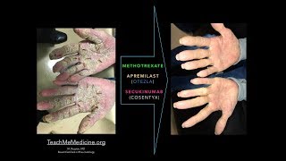 Apremilast Otezla SecukinumabCosentyx Methotrexate and Keratoderma [upl. by Afaw318]