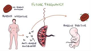 Understanding Rhesus Status and AntiD in Pregnancy [upl. by Meirrak145]