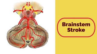 Brainstem Stroke Syndromes [upl. by Odlabso343]