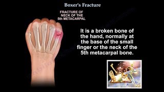 Boxers Fracture  Everything You Need To Know  Dr Nabil Ebraheim [upl. by Czarra423]