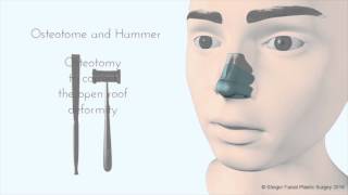 Breaking the Nose  Rhinoplasty Animation  Osteotomy [upl. by Atnima]