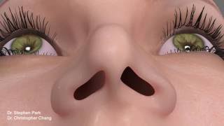 Pinched Narrow Nose Rhinoplasty to Address Nasal Obstruction [upl. by Emera]