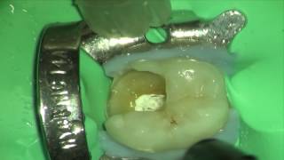 Simple Technique for PreEndodontic Restoration [upl. by Sevart]