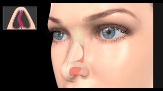 Deviated Septum Surgery Septoplasty [upl. by Miahc]