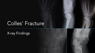 Colles Fracture Xray Findings [upl. by Menzies675]