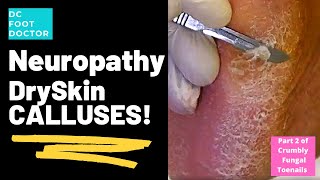 Neuropathy Dry Skin Calluses Part 2 of Crumbly Fungal Toenails [upl. by Aisset]