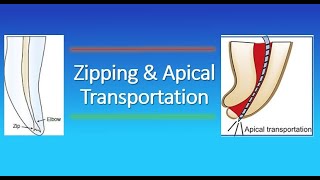 Zipping and Apical Transportation in Endodontics [upl. by Sheree]