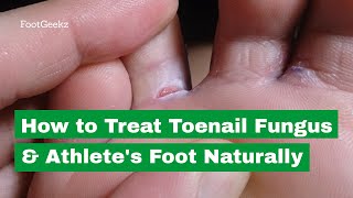 How to Treat Toenail Fungus amp Athletes Foot Naturally [upl. by Lyrahc]