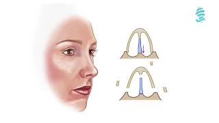 Rhinoplasty Detailed animation about the operation [upl. by Valery]