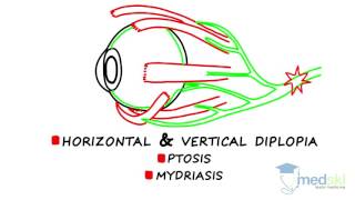 Ophthalmology – Diplopia By Martin ten Hove MD [upl. by Ruthy]