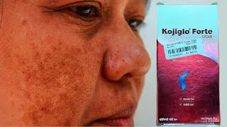 Kojiglo Forte Cream for Skin Lightening and Pigmentation  Review in Hindi [upl. by Wera767]