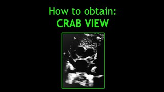 How to obtain CRAB VIEW Paediatric Echocardiography [upl. by Adalbert]