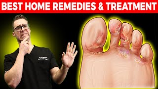 Athletes Foot Fungus BEST Home Remedies amp Treatment [upl. by Adrienne]